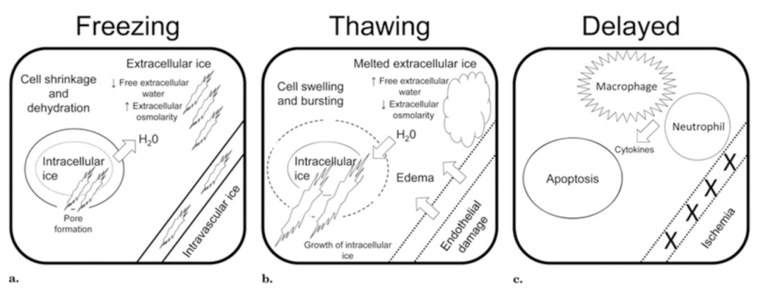 腫瘤治療界的「高冷之花」——腫瘤微創(chuàng)冷凍消融，國(guó)產(chǎn)替代設(shè)備空間巨大